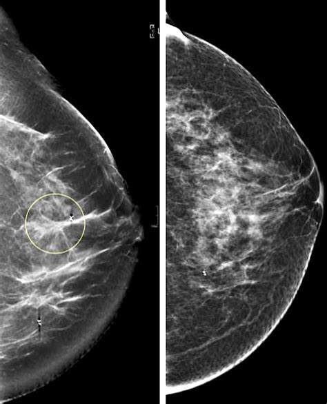 PHOTO GALLERY: What does breast cancer look like on mammography.